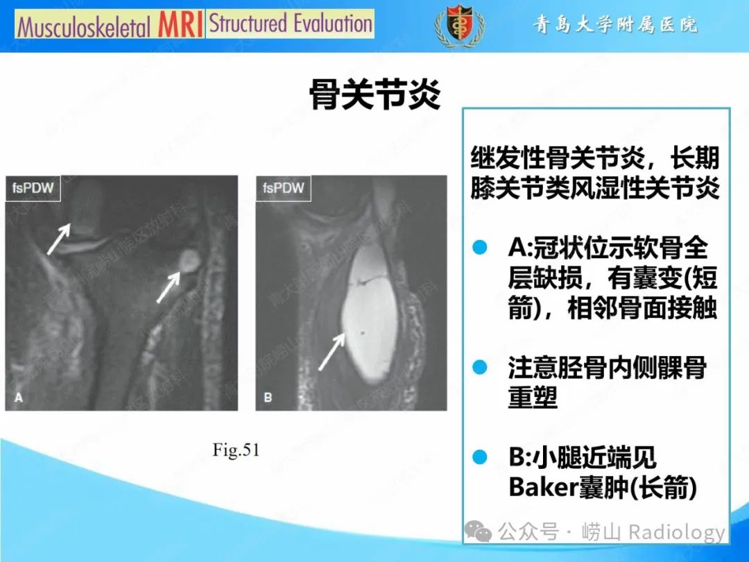 影像PPT - 【PPT】感染和炎症/关节炎-11