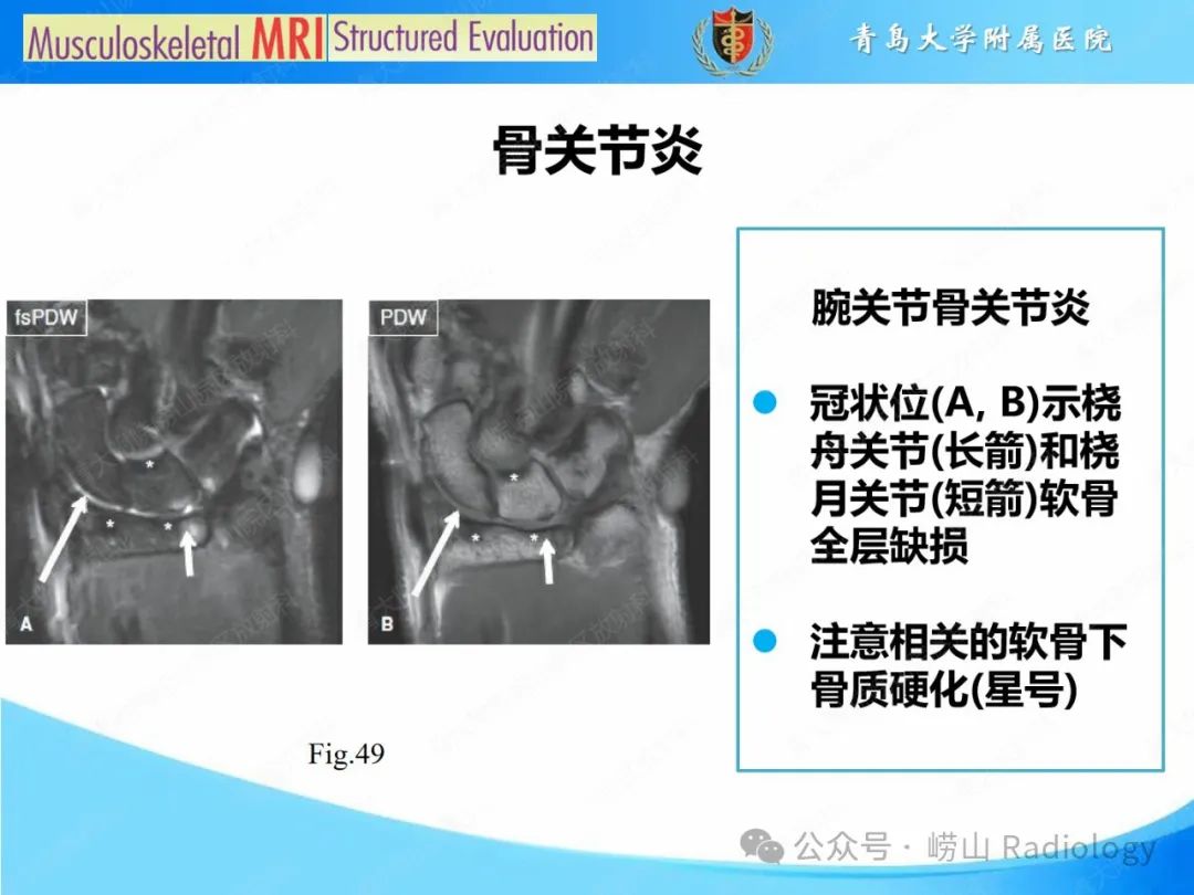 影像PPT - 【PPT】感染和炎症/关节炎-9