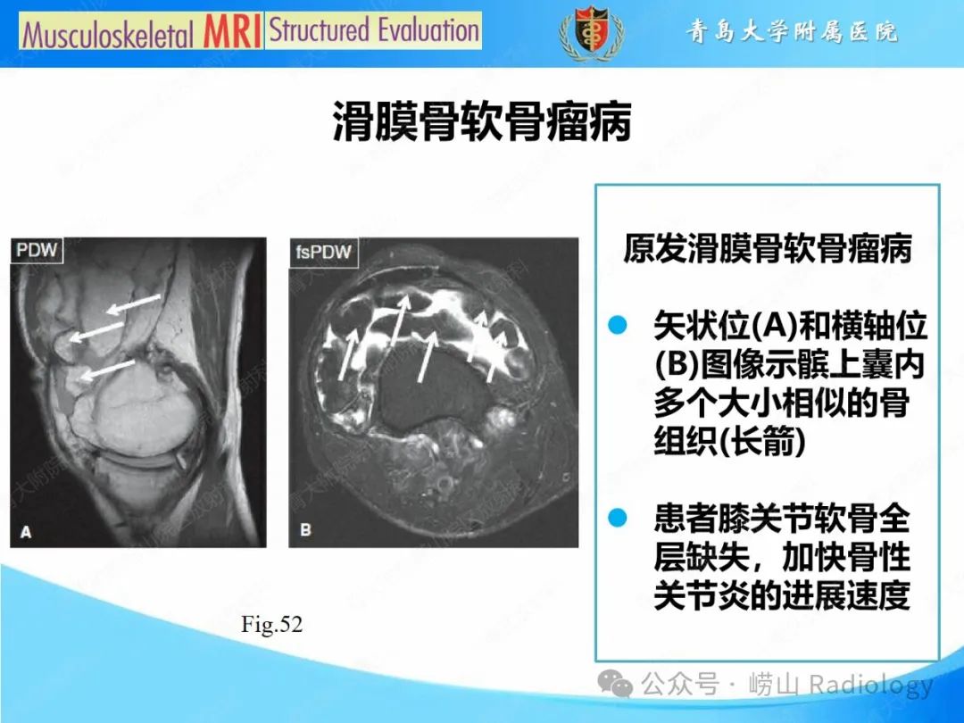 影像PPT - 【PPT】感染和炎症/关节炎-13