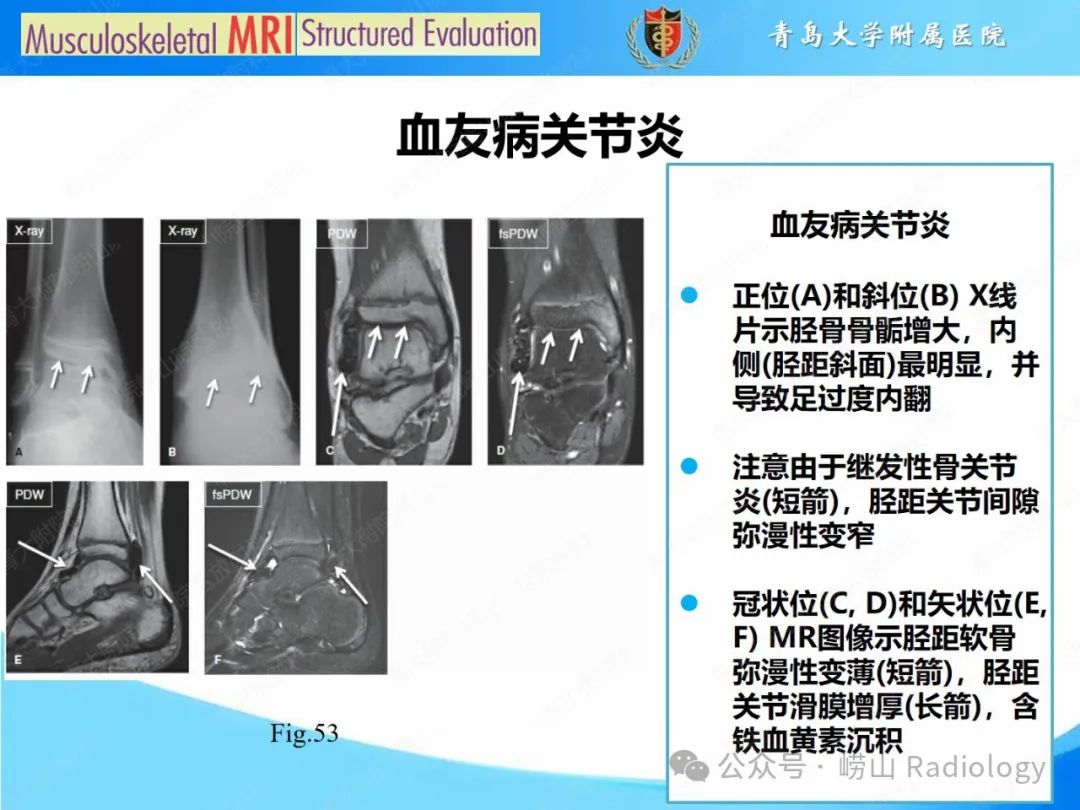 影像PPT - 【PPT】感染和炎症/关节炎-15