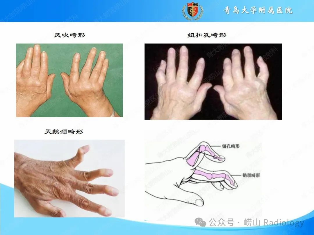 影像PPT - 【PPT】感染和炎症/关节炎-19
