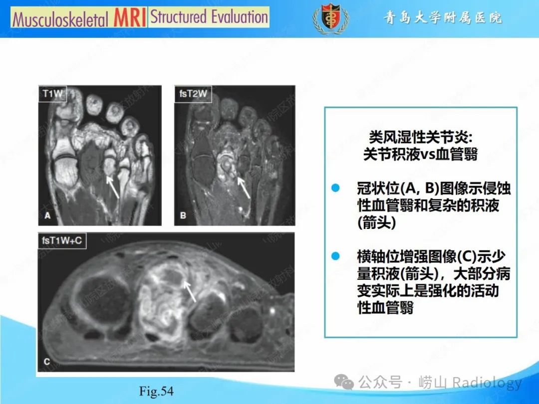 影像PPT - 【PPT】感染和炎症/关节炎-22