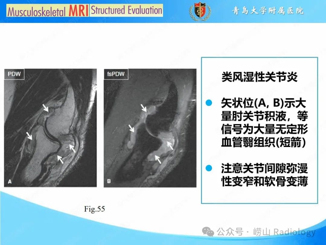 影像PPT - 【PPT】感染和炎症/关节炎-24