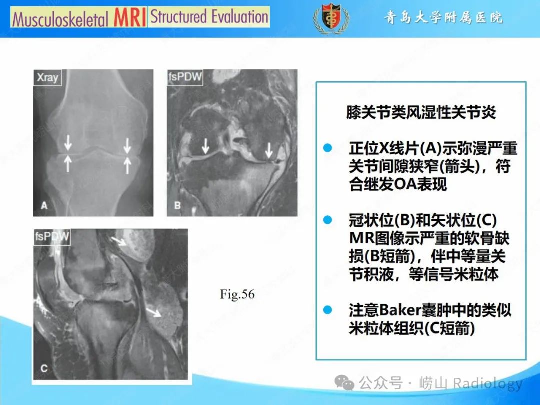 影像PPT - 【PPT】感染和炎症/关节炎-25