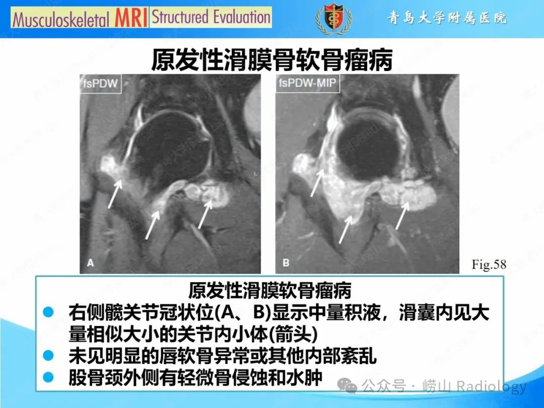 影像PPT - 【PPT】感染和炎症/关节炎-29