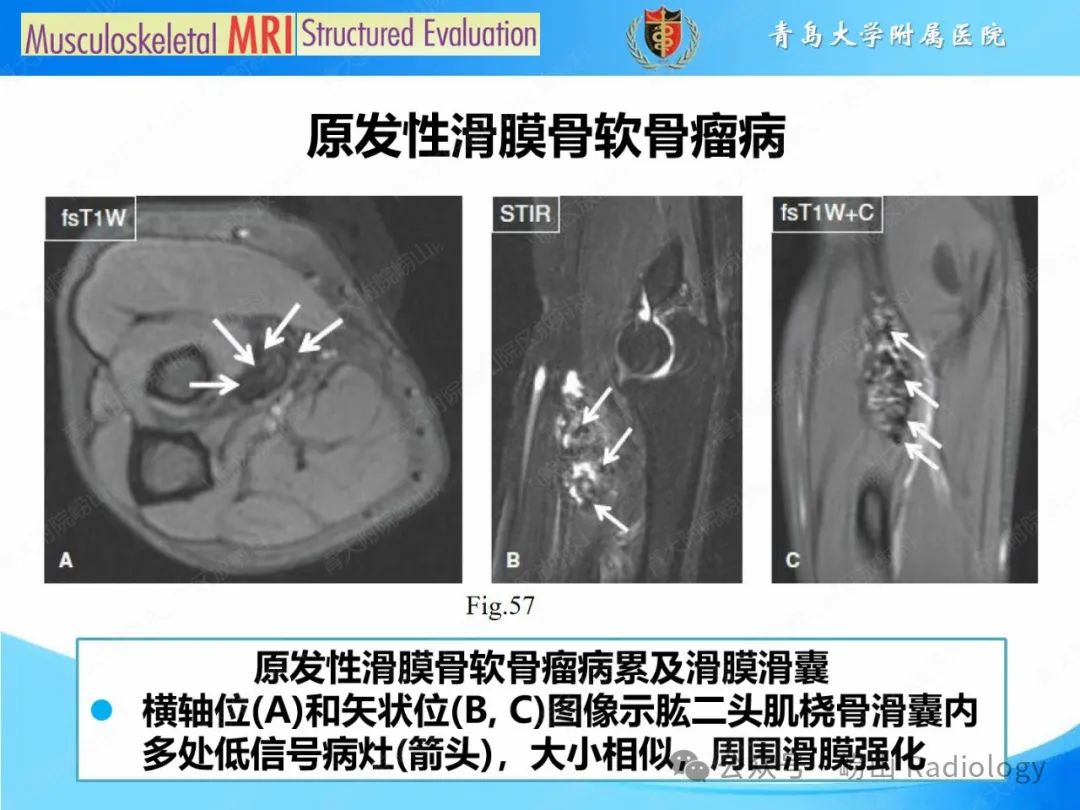 影像PPT - 【PPT】感染和炎症/关节炎-31