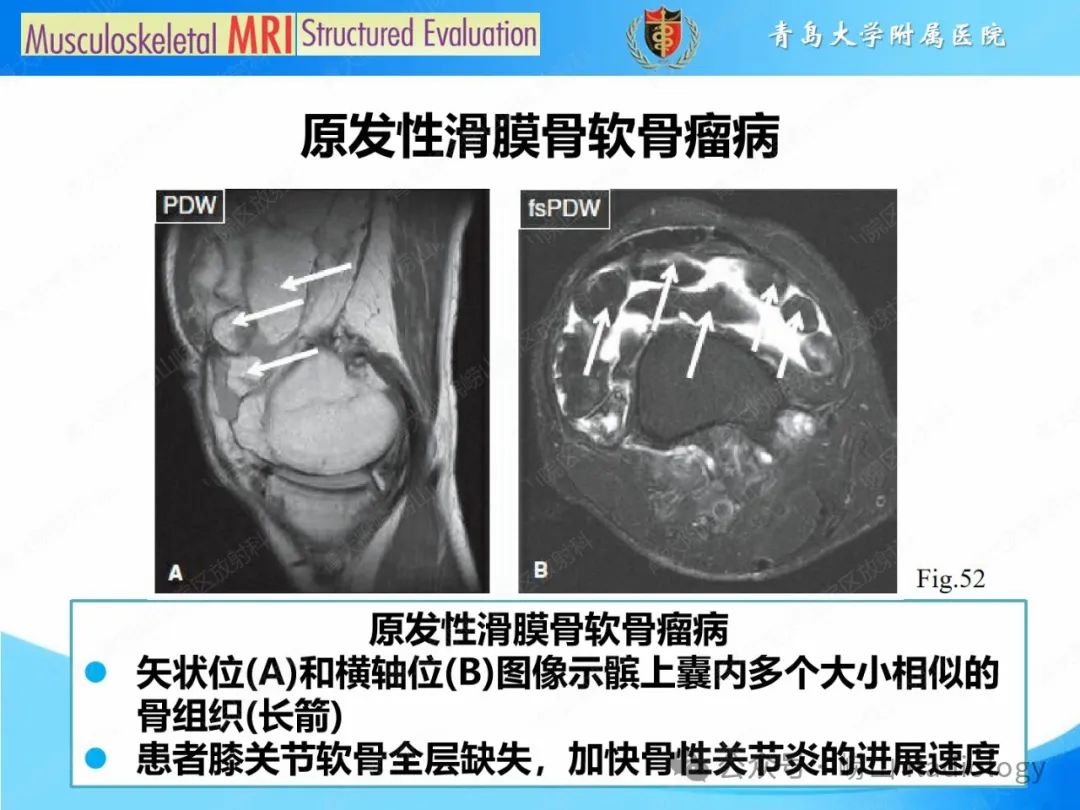 影像PPT - 【PPT】感染和炎症/关节炎-32