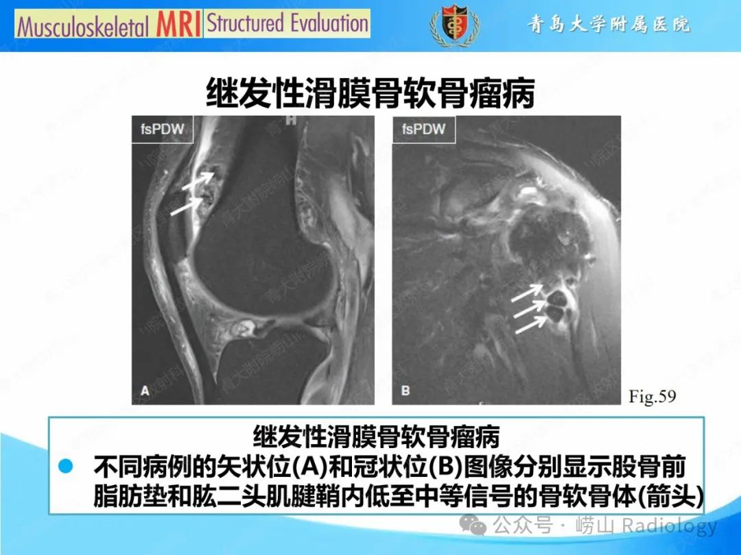 影像PPT - 【PPT】感染和炎症/关节炎-34