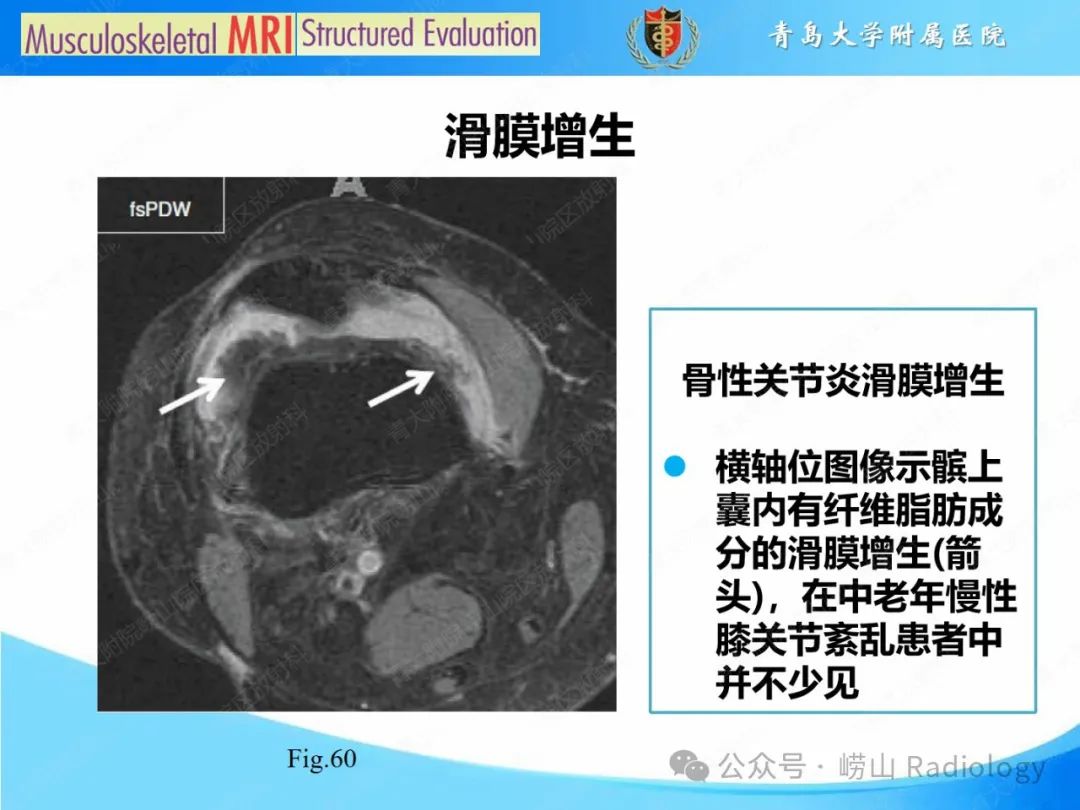影像PPT - 【PPT】感染和炎症/关节炎-37