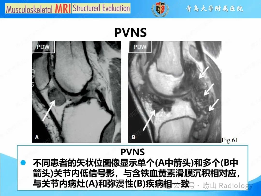 影像PPT - 【PPT】感染和炎症/关节炎-41