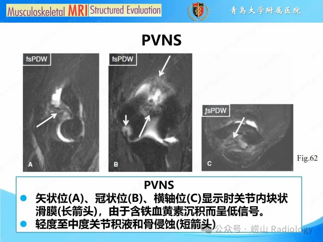 影像PPT - 【PPT】感染和炎症/关节炎-42