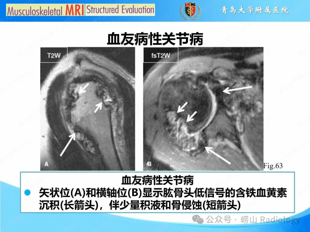 影像PPT - 【PPT】感染和炎症/关节炎-44