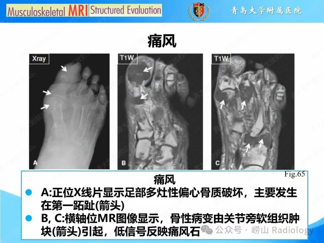 影像PPT - 【PPT】感染和炎症/关节炎-46