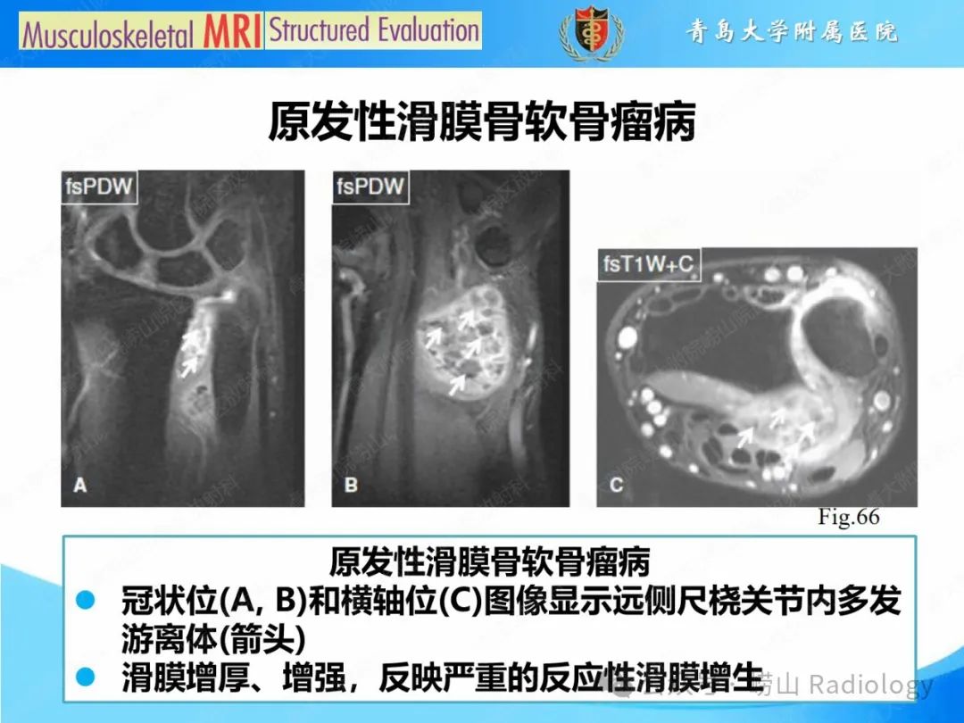 影像PPT - 【PPT】感染和炎症/关节炎-47