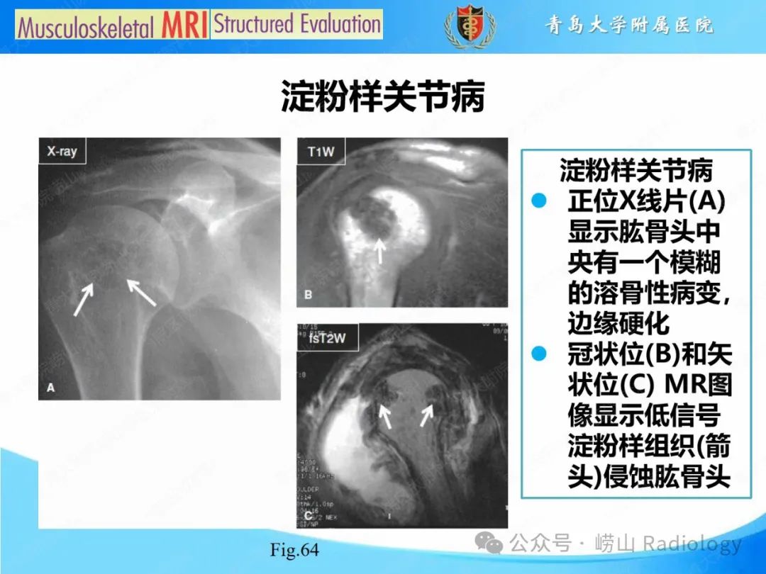 影像PPT - 【PPT】感染和炎症/关节炎-45