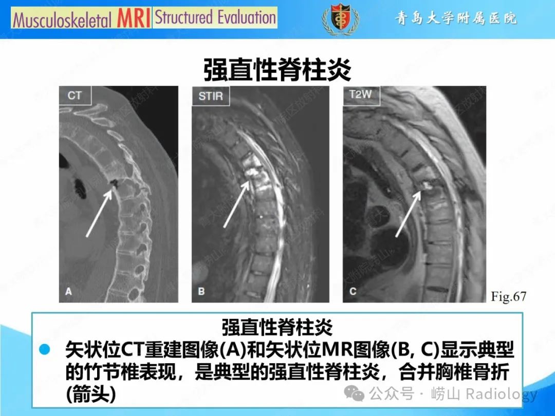 影像PPT - 【PPT】感染和炎症/关节炎-53