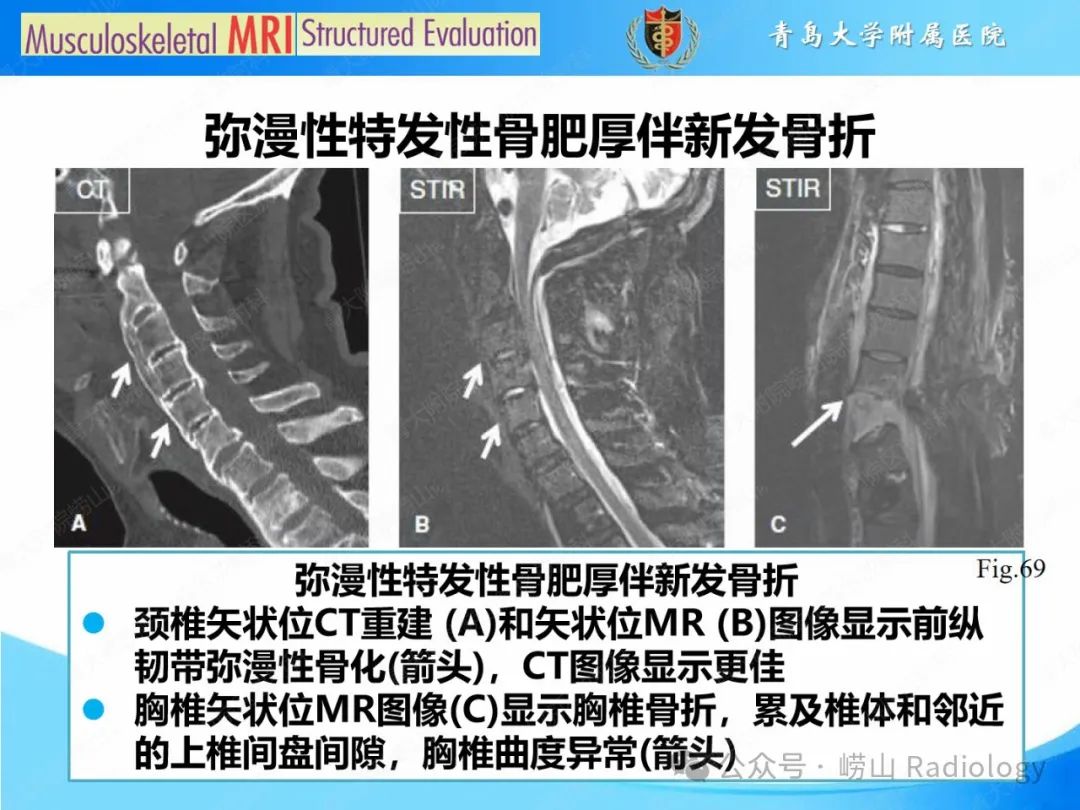 影像PPT - 【PPT】感染和炎症/关节炎-57