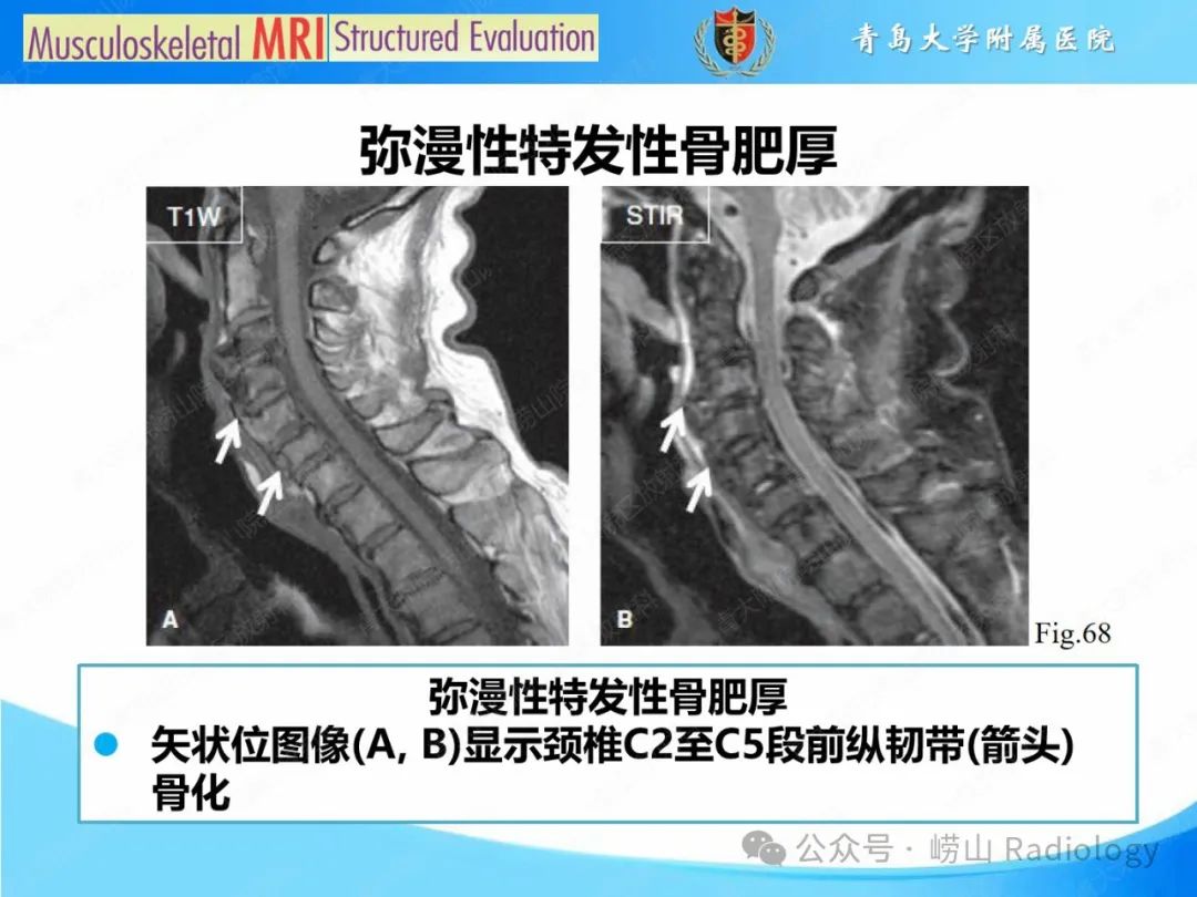 影像PPT - 【PPT】感染和炎症/关节炎-56