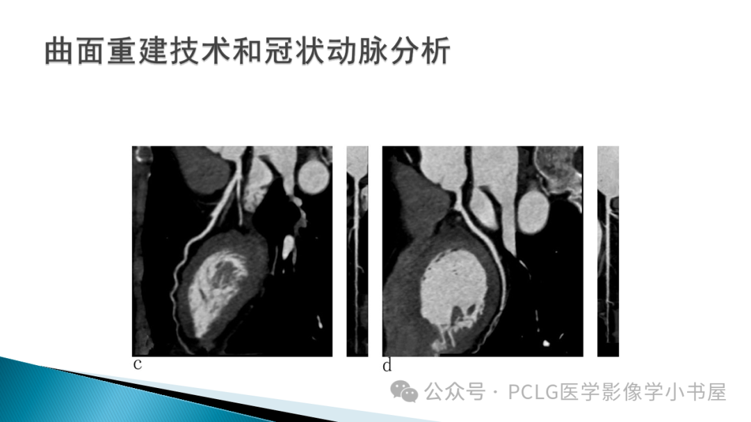 影像PPT - 【PPT】冠状动脉CTA检查方法及影像诊断-9