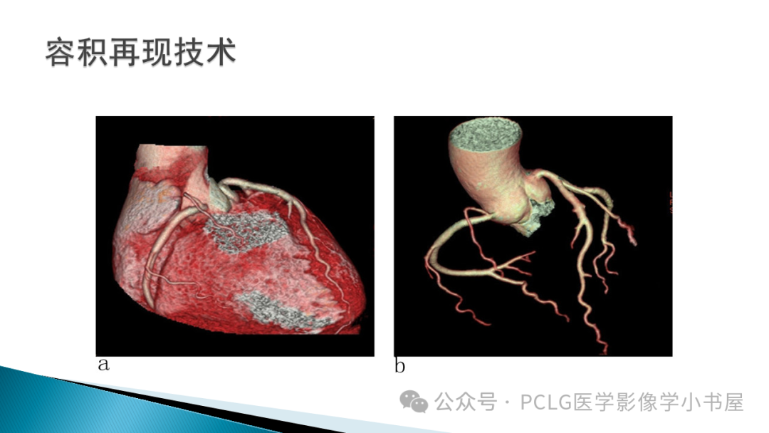 影像PPT - 【PPT】冠状动脉CTA检查方法及影像诊断-8