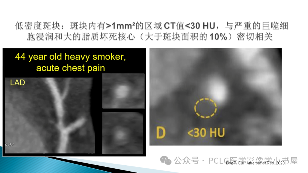 影像PPT - 【PPT】冠状动脉CTA检查方法及影像诊断-28