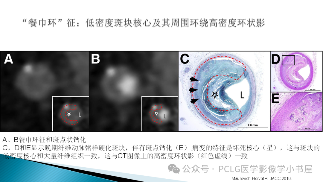 影像PPT - 【PPT】冠状动脉CTA检查方法及影像诊断-31