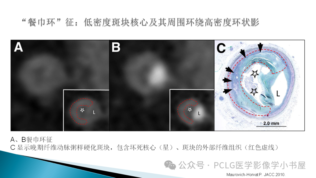 影像PPT - 【PPT】冠状动脉CTA检查方法及影像诊断-32